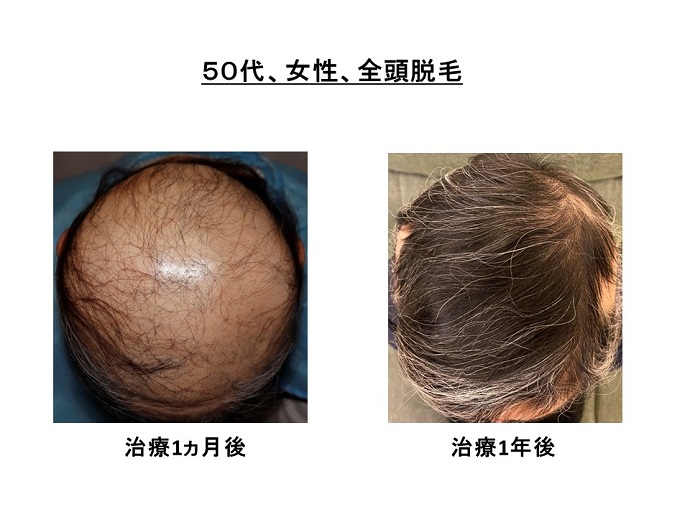 円形脱毛症　病院
